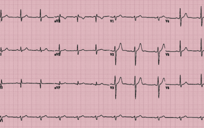 Ekg